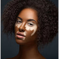 Vitiligo