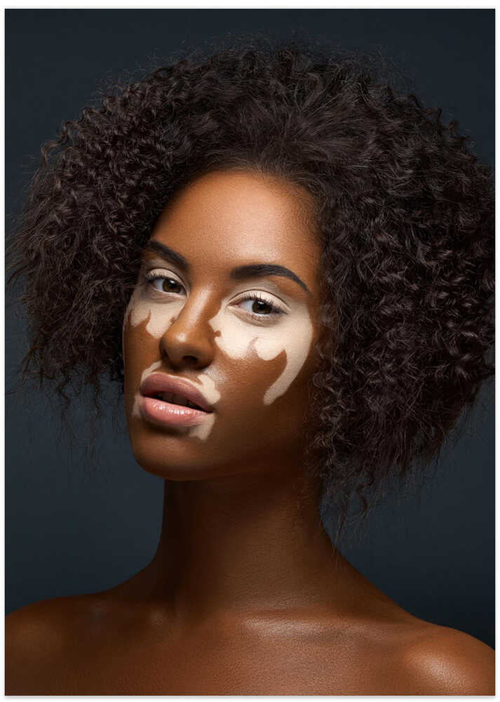 Vitiligo